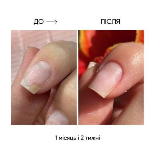 Олія для лікування оніхолізису Onistop Nails Of The Day, 15 мл
