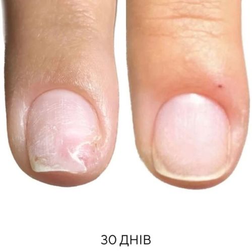 Олія для лікування оніхолізису Onistop Nails Of The Day, 15 мл