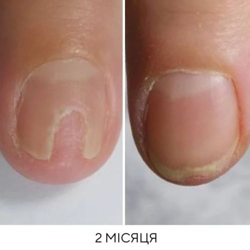 Олія для лікування оніхолізису Onistop Nails Of The Day, 15 мл