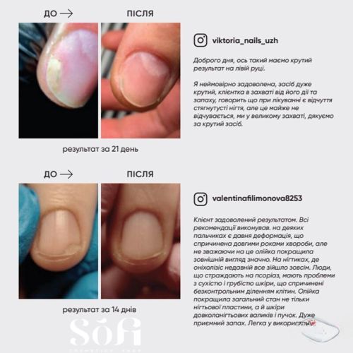 Олія для лікування оніхолізису Onistop Nails Of The Day, 15 мл