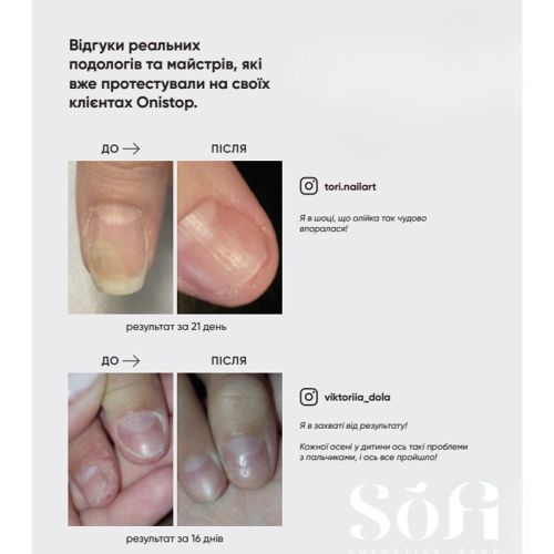 Масло для лечения онихолизиса Onistop Nails Of The Day, 15 мл